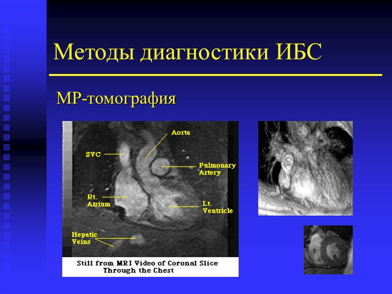 Методы диагностики ИБС МР-томография
